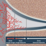 ménisque vasculaire