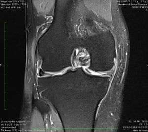 ménisque lesion IRM