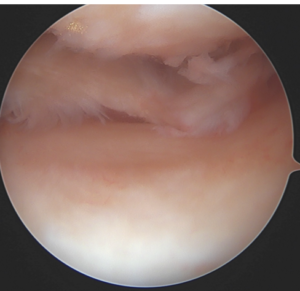 ménisque lesion degenerative